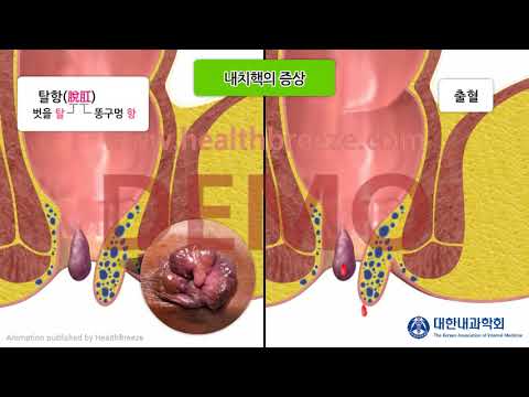 [시연용] a0151aako_[대한내과학회] 치질(치핵)