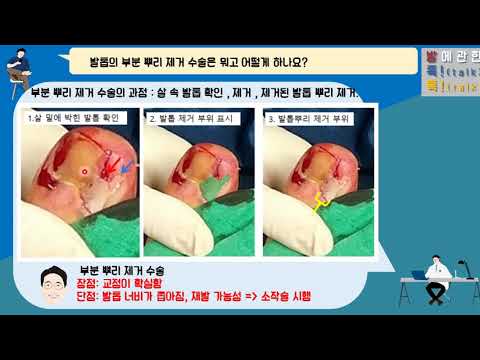 {발에관한 톡!톡!}, 내성 발톱의 수술적 치료: 부분 뿌리 제거수술의 실제 사례 {발에관한 톡!톡!}, 내성 발톱의 수술적 치료: 부분 뿌리 제거수술의 실제 사례