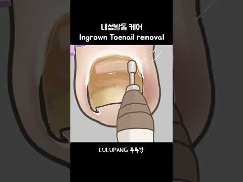 내성발톱 케어 한국인속도 Ingrown Toenail Removal 내성발톱 케어 한국인속도 Ingrown Toenail Removal