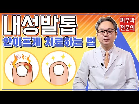 내성발톱! 안 아프게 치료하는 법! 내성발톱! 안 아프게 치료하는 법!