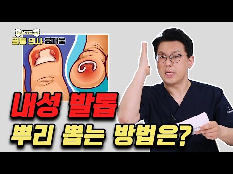 자꾸 재발하는 ‘내성 발톱’ 이렇게 치료하세요! - 골통 의사 윤재웅 #69 내성발톱 자꾸 재발하는 ‘내성 발톱’ 이렇게 치료하세요! - 골통 의사 윤재웅 #69 내성발톱