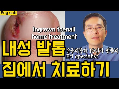똑닥자가치료 내성발톱 집에서 치료하는 법 (내성향발톱) #똑닥 #똑소리닥터 똑닥자가치료 내성발톱 집에서 치료하는 법 (내성향발톱) #똑닥 #똑소리닥터