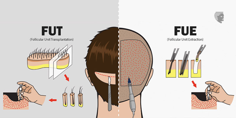 What Are The Advantages And Disadvantages Of Hair Transplant? - Ahs India