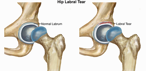 Hip Labral Tear - 8 Proven Exercises To Alleviate Hip Pain - Integrative  Spine & Sports
